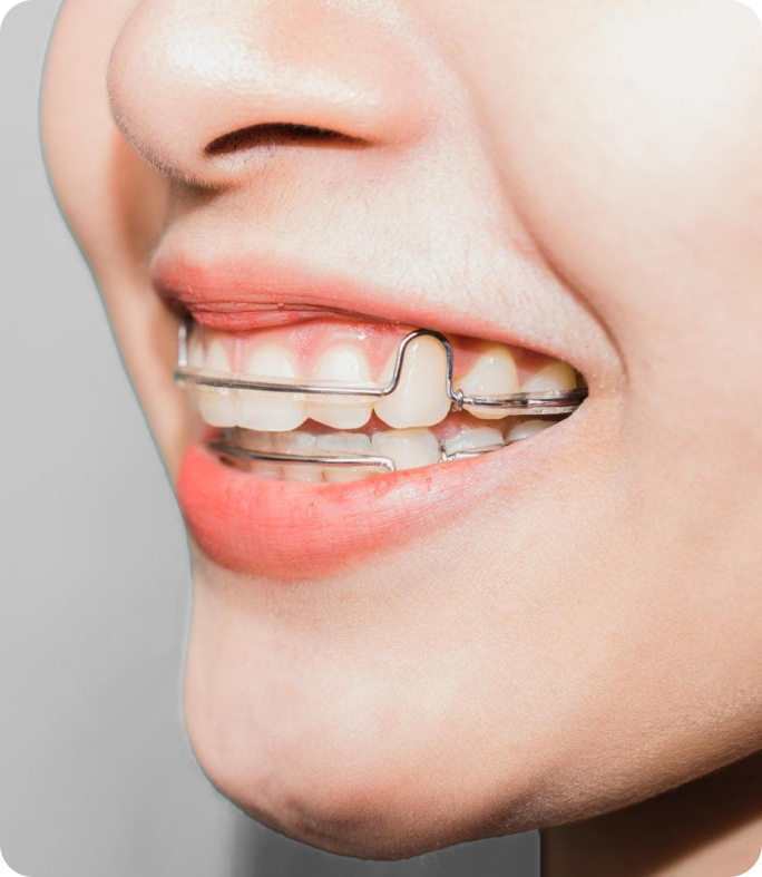 smiling girl wearing retainer